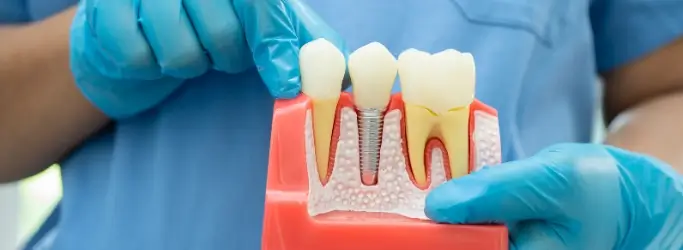 Dentist holding dental implants in Tulsa, OK